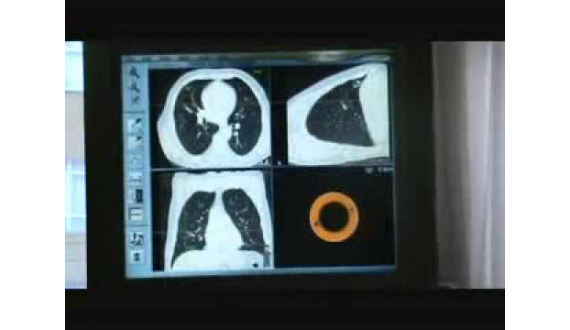 girişimsel bronkoloji,Bronchoscopy (Diagnostic Test)